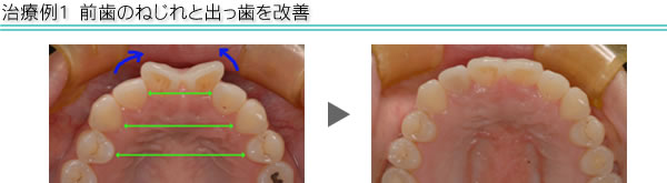 治療例1　前歯のねじれと出っ歯を改善