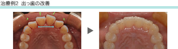 治療例2　出っ歯の改善