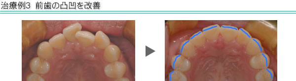 治療例3　前歯の凸凹を改善