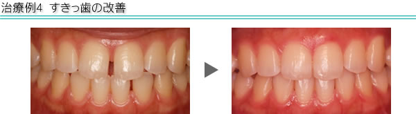 治療例4　すきっ歯の改善