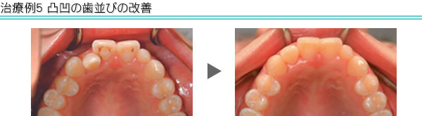治療例5　すきっ歯の改善