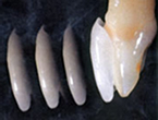症例1:前歯の小さい歯をきれいな形にしたい