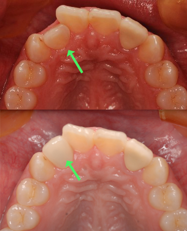 occlusal.before after.jpg